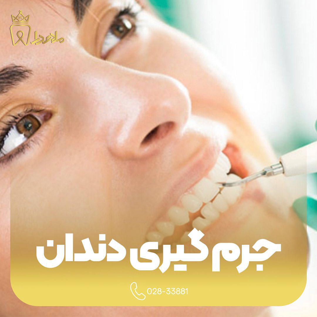 جرم گیری دندان
